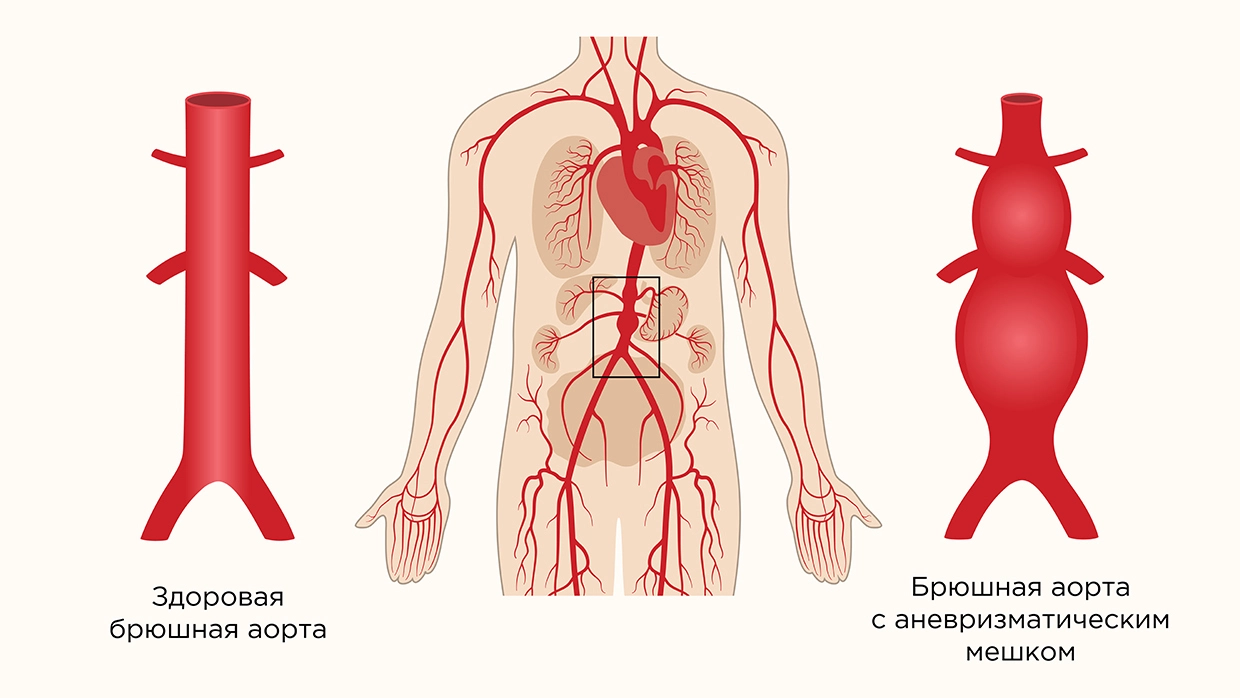 Аневризма аорты